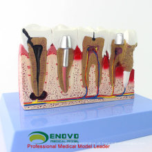 IMPLANTE DENTAL ATACADO 12625-1 Implantes Dentários de Grandes Dimensões Modelos Médicos Didáticos